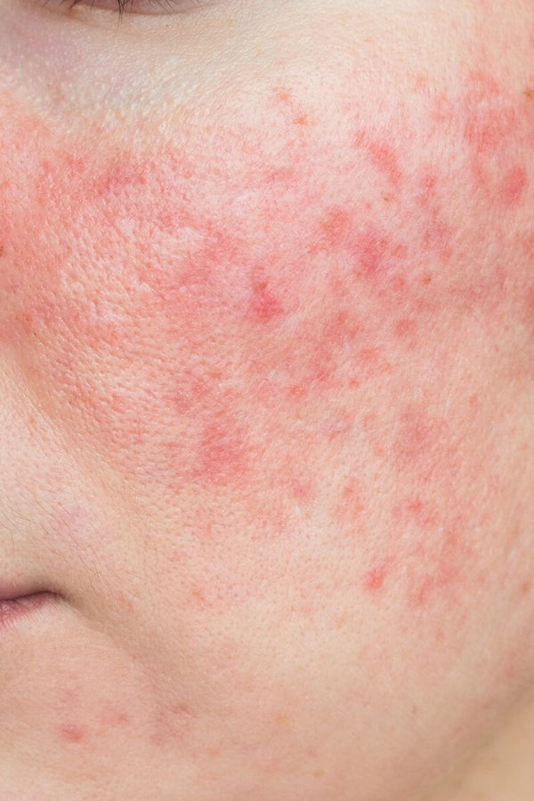 Redness + Rosacea