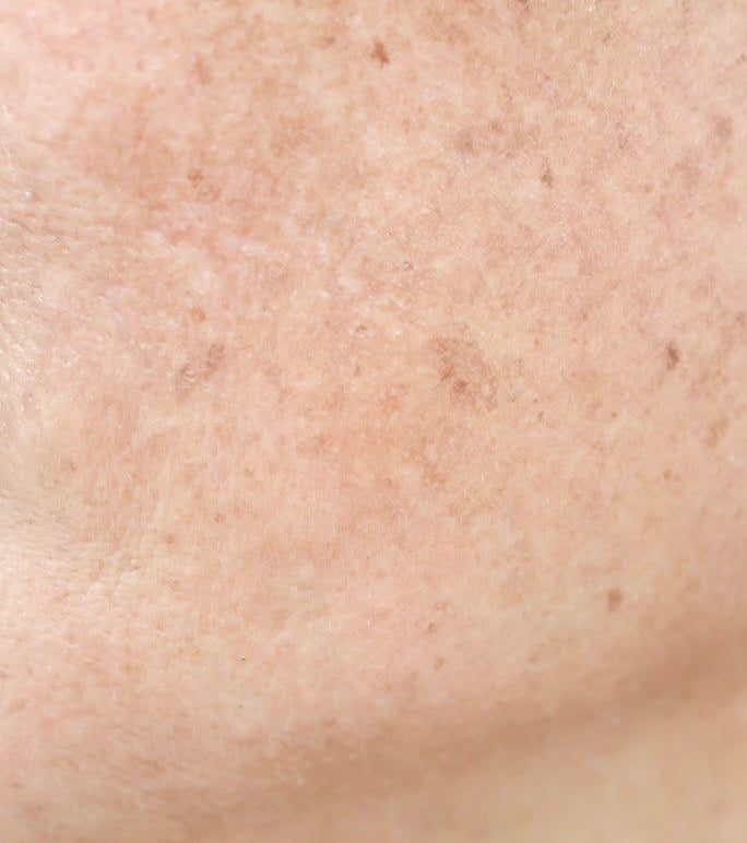 Hyperpigmentation