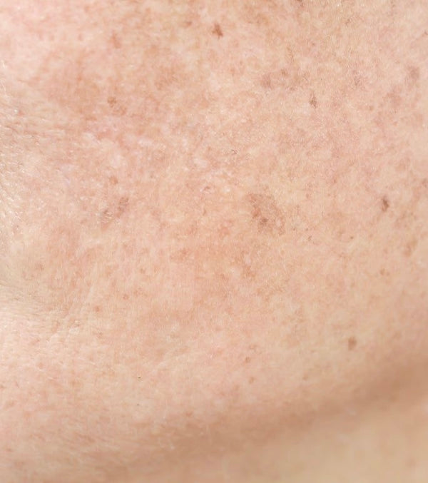 Hyperpigmentation
